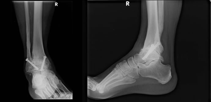 Arthroskopisch durchgeführte Versteifungsoperation des oberen Sprunggelenkes, die Röntgenbilder unmittelbar nach der Operation